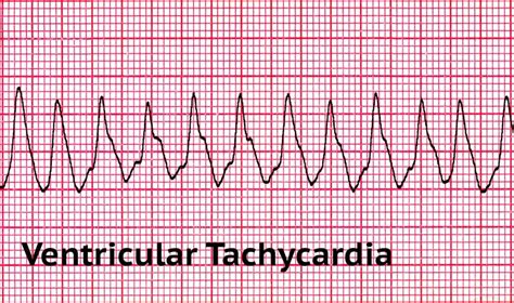 What are the Two Shockable Rhythms in Cardiac Arrest? - Free CPR Training