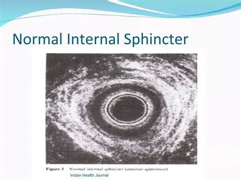 Open lateral internal sphincterotomy | PPT