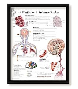 wallsthatspeak Atrial Fibrillation and Ischemic Strokes Framed Medical ...
