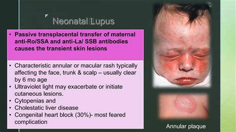 Pediatric systemic lupus erythematosus | PPTX
