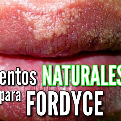 Grânulos De Fordyce Como Eliminar - RETOEDU