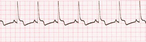 Image result for Synchronized Cardioversion EKG Strips Practice