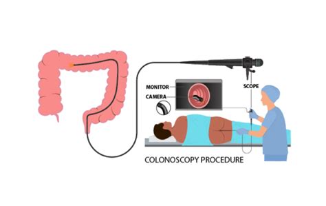 Getting a Colonoscopy 的图像结果