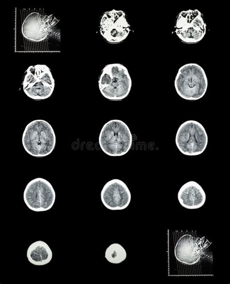 Image result for Normal Brain CT Scan Head