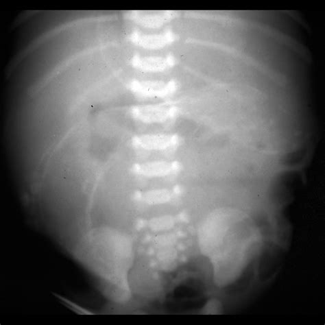 Newborn with a distended abdomen | Pediatric Radiology Case | Pediatric ...