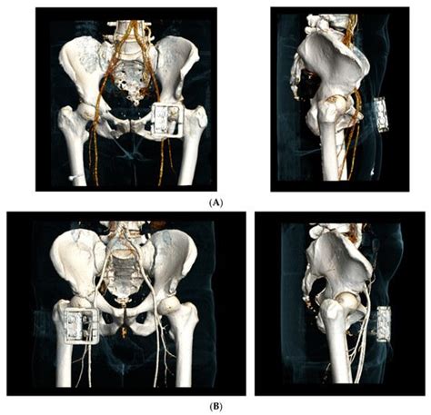 Application of Pelvic Circumferential Compression Devices in Pelvic ...