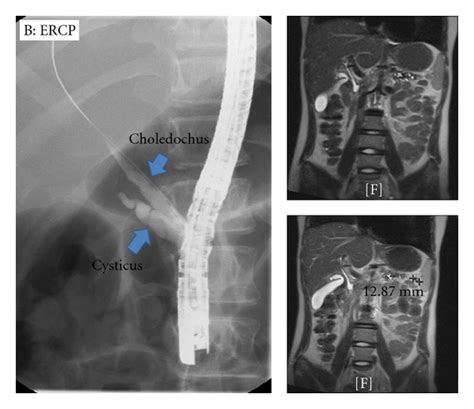 Image result for MRCP Biliary Tree