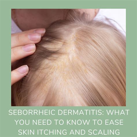 Sea Salt Water For Seborrheic Dermatitis at Preston Lamb blog