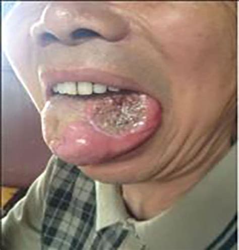常见舌癌早期症状表现图片_有来医生