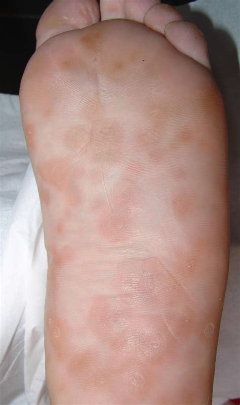 Syphilis stages, signs, symptoms, diagnosis, treatment and syphilis cure