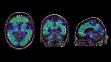 Beta-amyloid PET/CT imaging in the assessment of memory loss and dementia - Siemens Healthineers USA