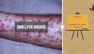 smallpox 的图像结果