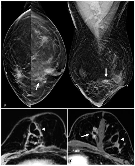 Imaging Features Following Breast Explant Surgery: A Pictorial Essay