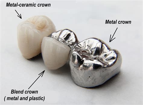 Dental Crown Raw Material at Noah Janet blog