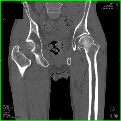 Impacted Fracture Left Femoral Neck - Trauma Radiology Case Studies ...