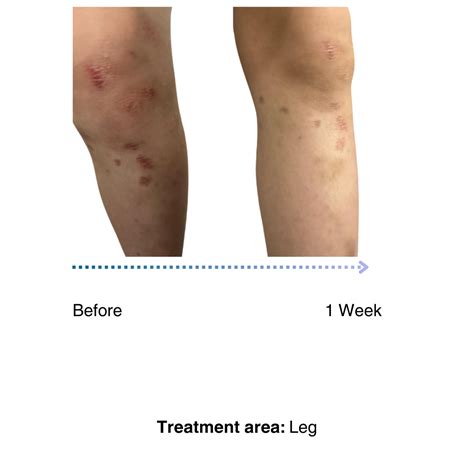 Eczema Treatment Without Steroids: Choices for Skin