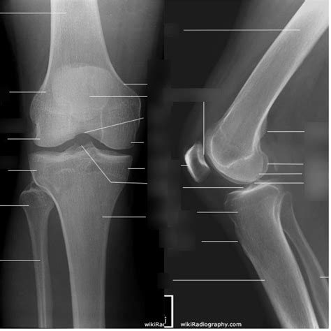 Label The X-Ray Of The Knee at Leroy Olson blog