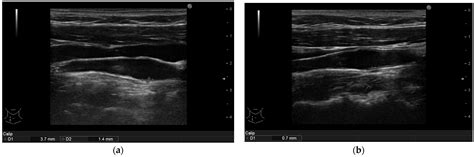Impact of Interleukin-17 Inhibitor Therapy on Arterial Intima-media ...