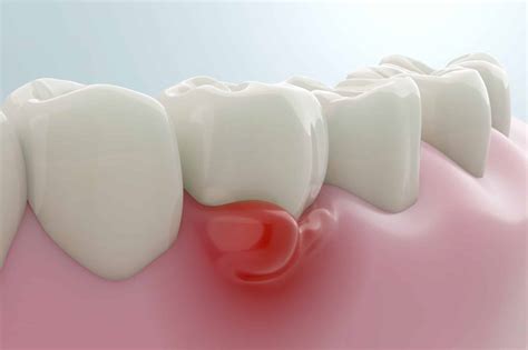 Can Gum Disease Kill You? - Smile Vegas Dental