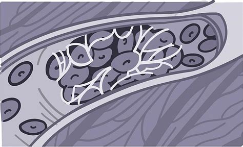 Blood Clots Explained | NIH News in Health