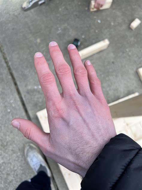 Why do my hands get like this in the cold? : r/medical_advice