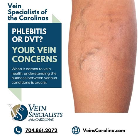 SuperficialThromboPhlebitis Archives - Vein Specialists of the Carolinas