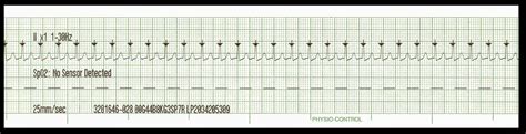 Image result for Synchronized Cardioversion EKG Strips Practice