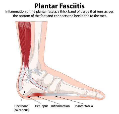 Plantar Fasciitis 的图像结果
