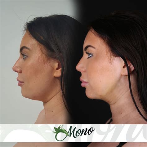 Double Chin Liposuction in Clinic Mono in 2025