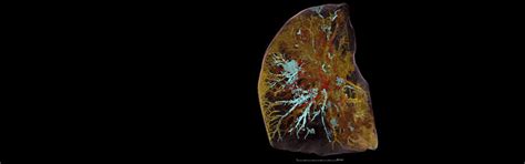 New X-Ray Technique Shows COVID-19 Lung in Unprecedented Detail ...