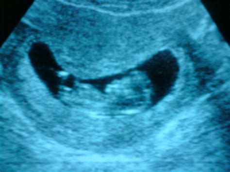 Malaysian Sonographer: Crown Rump Length