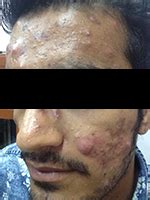 Know Your Skin Diseases - Check Your Symptoms, Get Acne, Psoriasis ...