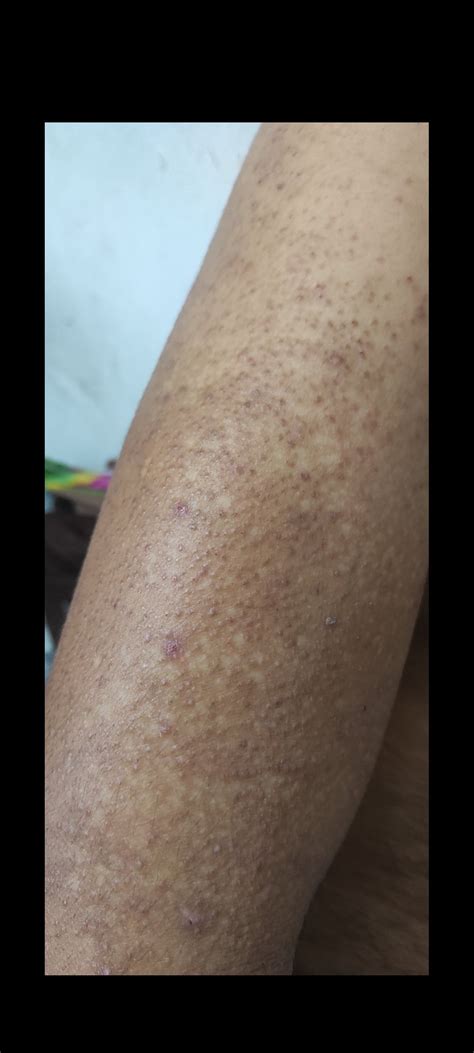 Extremely itchy bumps on my arms and legs what are these bumps? : r/dermatologisttorture