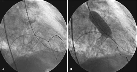 Emergency Percutaneous Balloon Aortic Valvuloplasty in Critical Aortic Stenosis with Hemodynamic ...