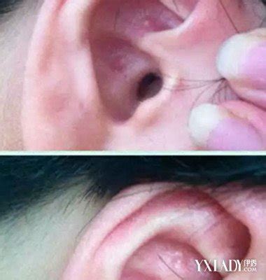 【图】耳朵下长痘痘是什么原因 该如何解决这个问题呢(3)_耳朵下长痘痘是什么原因_伊秀美容网|yxlady.com