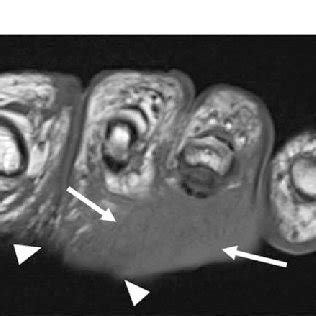 Image result for Devitalized Tissue Example