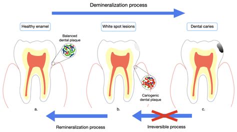 Analysis of Dental Enamel Remineralization: A Systematic Review of Technique Comparisons