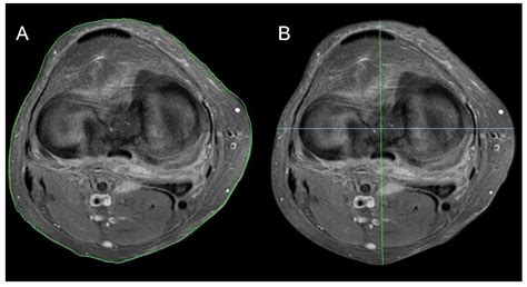 Mri Knee Axial