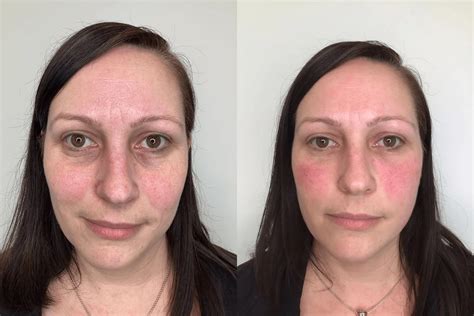 Lumi Eyes - Dr Aesthetica