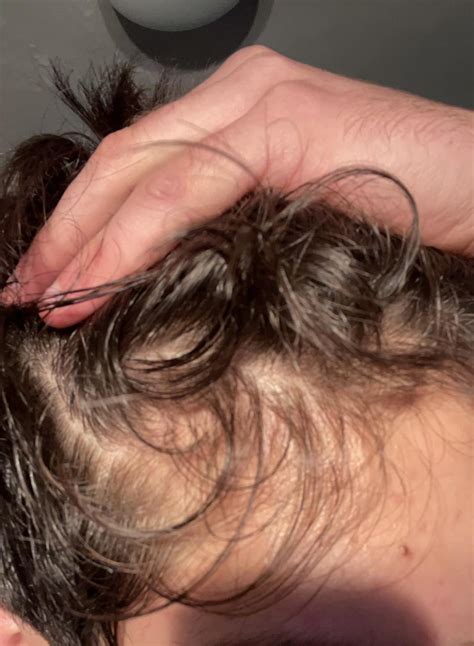 Image result for Diffuse Alopecia