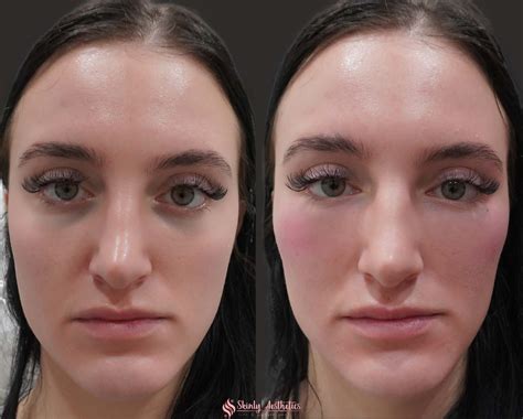Under Eye Fillers - Before & After Results at Skinly