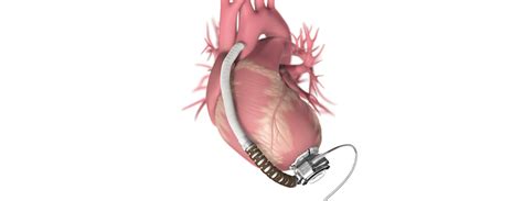 Ventricular Assist Device (VAD) | Conditions & Treatments | UCSF Health