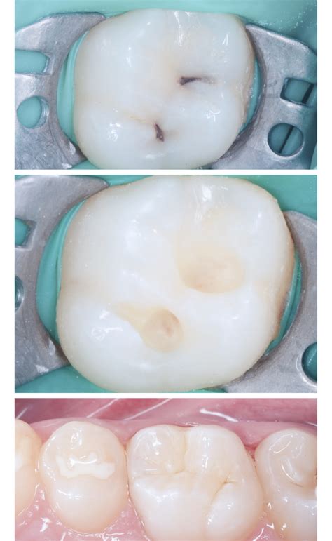 Dental caries treatment - Zaharenko Dental Clinic