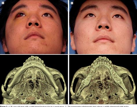 Zygomatic Complex Fracture