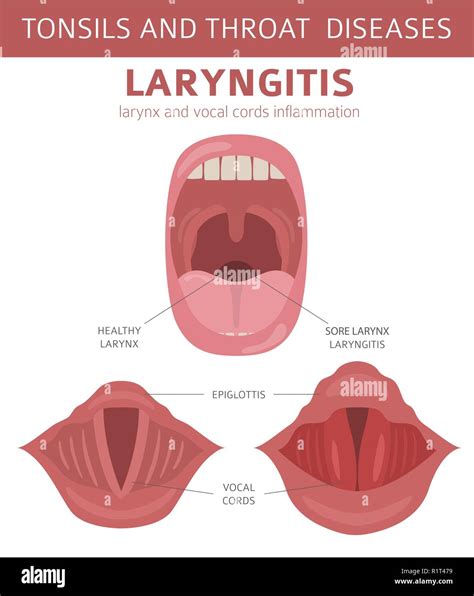 Tonsils and throat diseases. Laryngitis symptoms, treatment icon set. Medical infographic design ...