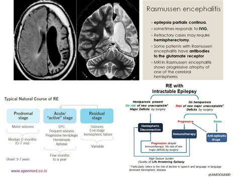 Rasmussen Encephalitis