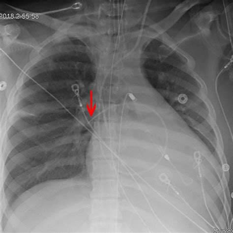 Image:Radiograph Showing Correct Placement of a Swan-Ganz Catheter-MSD Manual Professional Edition