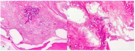 Corona-Associated Mucormycosis: Case Series Reports and Review of the ...