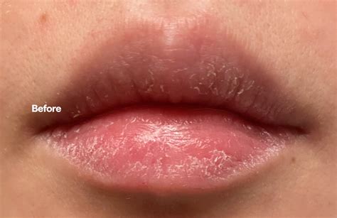 Image result for Pimple From Dry Lips