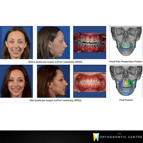 Corrective Jaw Surgery Glen Waverley | The Orthodontic Centre
